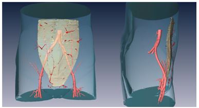 欒杰 乳房再造的微創(chuàng)化、精細(xì)化與個性化 4.jpg
