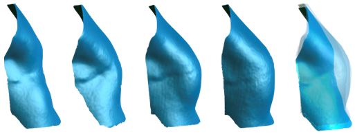 欒杰 乳房再造的微創(chuàng)化、精細(xì)化與個性化 5.jpg
