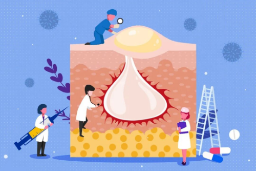 反常性痤瘡，是怎么回事？